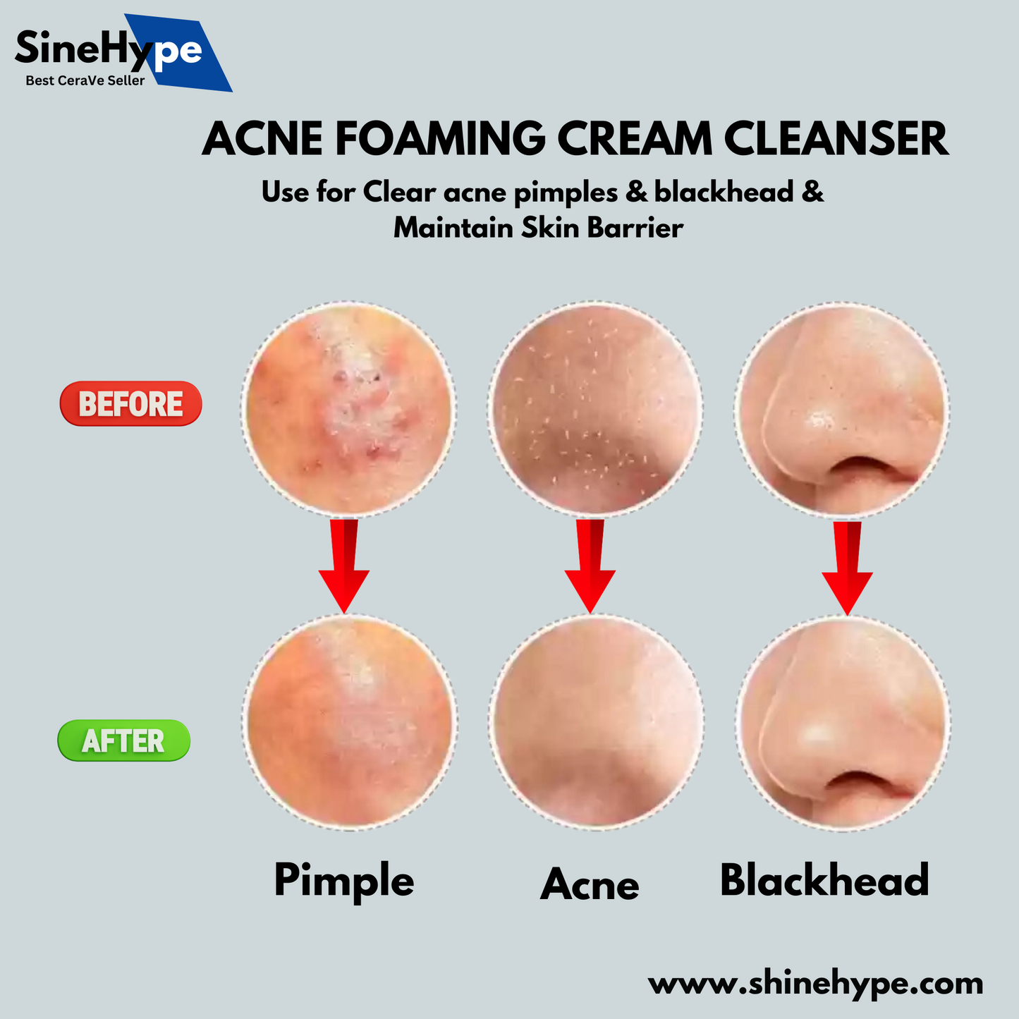 Acne Foaming Cream Cleanser 150ml